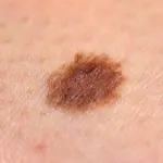 Il Melanoma: sintomi e prevenzione