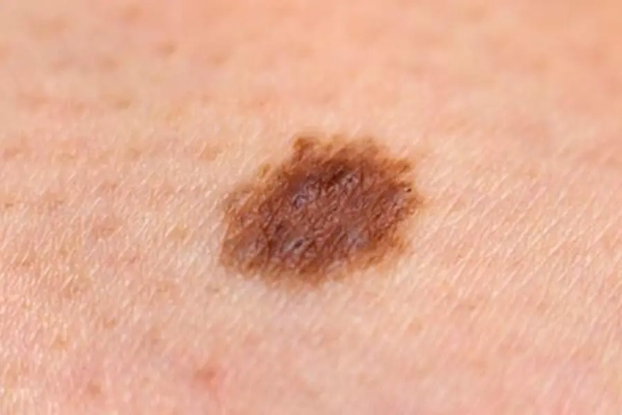 Il Melanoma: sintomi e prevenzione