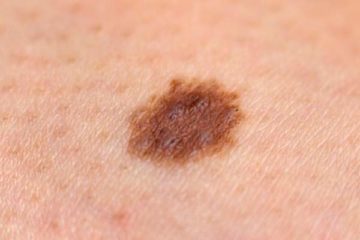 melanoma